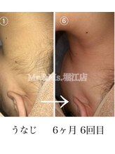 ミスターアンドミス 四ツ橋 堀江店(Mr.&Ms.)/レディースうなじ脱毛