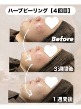 ビレボ マエバシ(BEREVO maebashi)/Before After