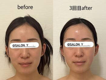 サロンワイアネシス(Salon y ANESIS)/小顔コルギ　3回の変化
