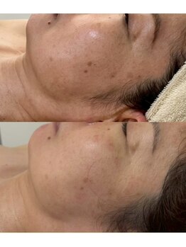 ウィンウィン 新山口店(Win Win)/たるみ、シミ改善