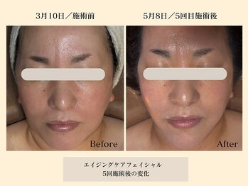 パンセリーノ(Panselinos)/エイジング120分コース5回施術後