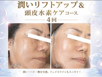 リベルテの写真/頭皮のケアと合わせて顔スッキリ！潤い、ハリ、艶を実感して理想のフェイスラインへ導く贅沢エステ◎