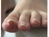 【いたみにサヨナラ！】足の巻き爪　専門フットケア ¥8,250