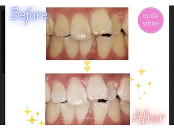 エクシアホワイトニング 可児店/ビフォーアフター