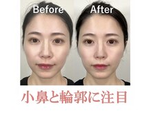 ラプリ 浜松店(Raplit)/ 隆鼻＋輪郭矯正40分1回