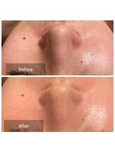 サロン ド R/■小鼻の黒ずみは皮脂の酸化です