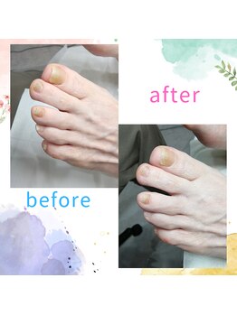 【肥厚・変形爪】ネイル/フット