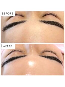 ラグラン銀座メディカルエステ 高輪ゲートウェイ店/進化系・コラーゲンピーリング