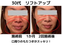 エンジェルエッグ/◆もたつく口周りがシュッと！