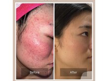 ベンザイ 梅田店(BENZAI)/肌荒れ、赤み、毛穴悩み