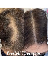 アイスブルー(Ice blue)/プロセルセラピーズBefore/After