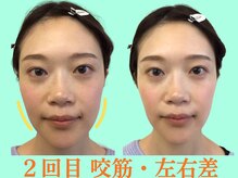 ナチュラルパーフェクトフェイス 新宿/2回目・フェイスラインスッキリ