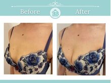 美人バスト 新潟店/ 【バストアップ★育乳】症例