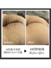 エリクサー 加須店(Elixir)/10回照射ビフォーアフター!