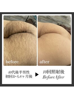 エリクサー 加須店(Elixir)/10回照射ビフォーアフター!
