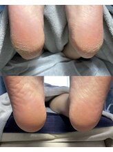 クラゲ(Kurage)/かかとのお悩みはここで解決♪