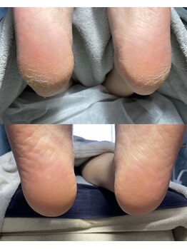 クラゲ(Kurage)/かかとのお悩みはここで解決♪
