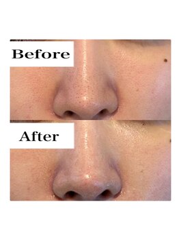 ライム 天神(LIME)/before&after 　赤みケアに