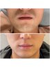 【メンズ】お試し部分脱毛　顔(ヒゲ)or脇or膝下 30分