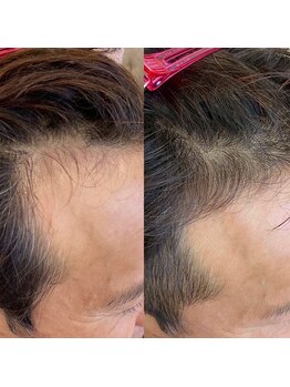 グラーティア(gratia)/プロセル育毛促進トリートメント