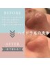 【ハイドラ美容液毛穴洗浄】毛穴汚れごっそり除去高保湿パック有¥5000→¥2500