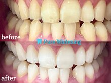 歯科提携セルフホワイトニングの驚きの白さを実感してください。