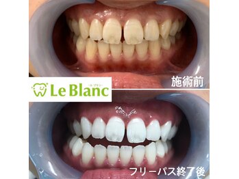 ルブラン 奈良店(Le Blanc)/歯の黄ばみ落とせます！
