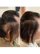 アイスブルー(Ice blue)/プロセルセラピーズBefore/After