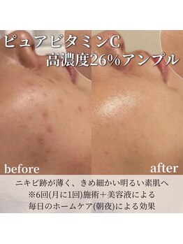 エムラボ 麻布十番店(M LABO)/イオン導入