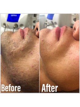 脱毛専門店 美的の写真/メンズ脱毛で日々のヒゲ剃りが楽に◎今年の夏は肌も自分も魅せる夏に！レディースVIO脱毛は￥4,950～！