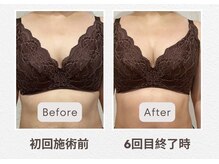 東広島西条整骨院/40代　バストアップ実績