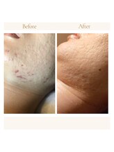 インプレス ラミール/～２年での変化