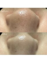 リメレ(Rimere)/毛穴洗浄×プラズマ微細針