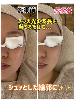 ポアレスサロン フィル(fil)/純国産光フェイシャル&光脱毛