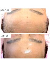 ラグラン銀座メディカルエステ 高輪ゲートウェイ店/ 自分史上!超絶最強毛穴レス美肌