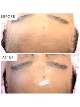 ラグラン銀座メディカルエステ 高輪ゲートウェイ店/ 自分史上!超絶最強毛穴レス美肌