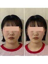 サロン ウェル(SALON WELL)/【20代 小顔/リフトアップ】