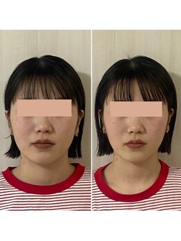 サロン ウェル(SALON WELL)/【20代 小顔/リフトアップ】