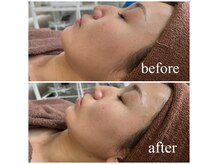 速攻小顔超音波[小顔/毛穴/ホワイトニング］