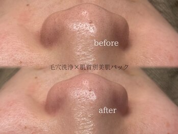 レア(Lea)の写真/【堺東/毛穴洗浄】乾燥肌やオイリー肌など肌質に合わせた施術で肌トラブルに直接アプローチ◎