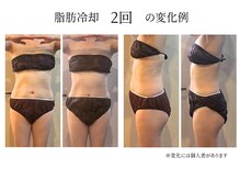 ビーサロン(B-salon)/脂肪冷却2回の変化