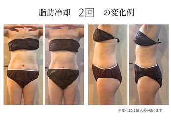 ビーサロン(B-salon)/脂肪冷却2回の変化
