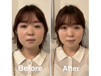 ザ ハイライト 恵比寿/小顔矯正とフェイシャルの結果☆
