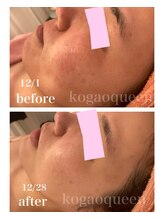 小顔クイーン 荻窪店/プロセル×LDM水玉リフティング