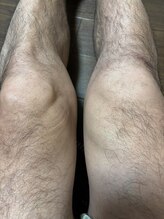 ライズ/お膝への施術