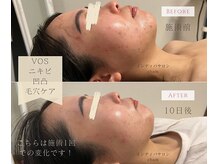 チャム(cham)の雰囲気（インディバ＋VOSの相乗効果で毛穴レスなツヤ肌小顔美人に★）