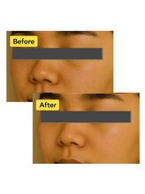 シャムロック/ピーリング！ビフォーアフター