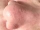 ピーチ(Peach)の写真/浮き出る角栓に驚き!!”毛穴洗浄コース”が人気急上昇〇小鼻・額・頬など毛穴や角栓・ごわつき速攻除去