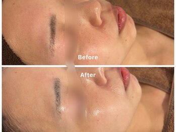 サロンアルーナ(Salon a Luna)/剥離しないハーブピーリング