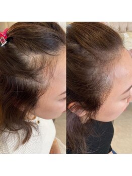 アイスブルー(Ice blue)/プロセルセラピーズBefore/After